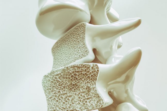 huesos en 3d con osteoporosis